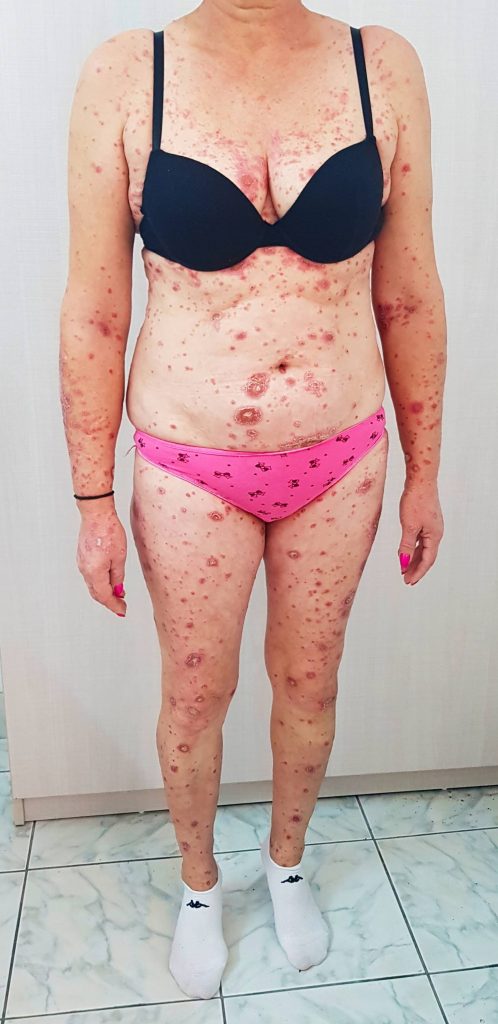 Psoriazis - before - 1