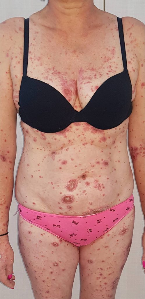 Psoriazis - before - 2