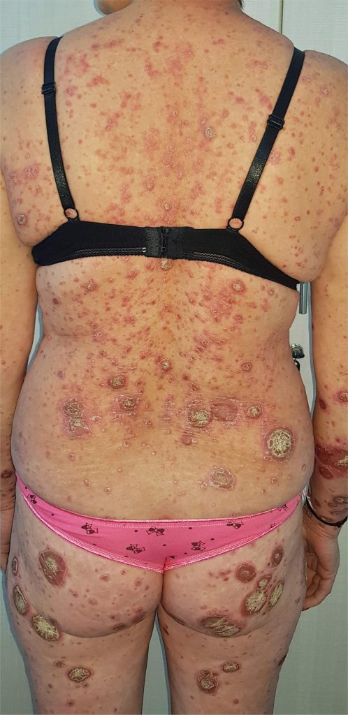 Psoriazis - before - 3