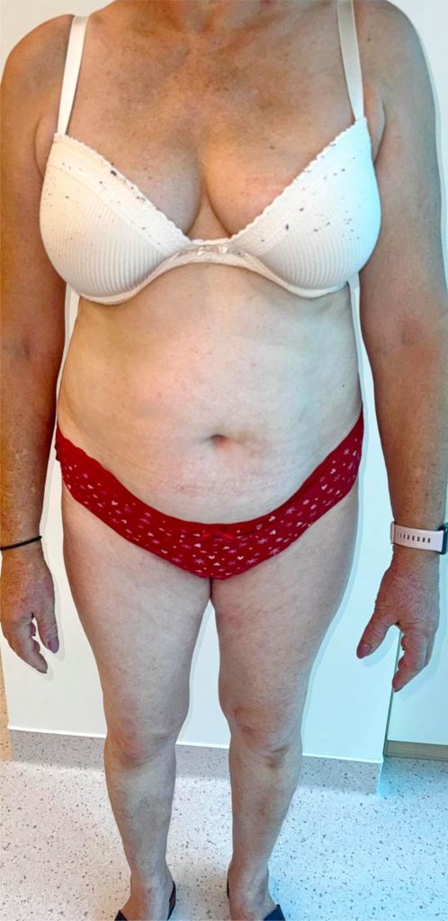 Psoriazis - before - 4