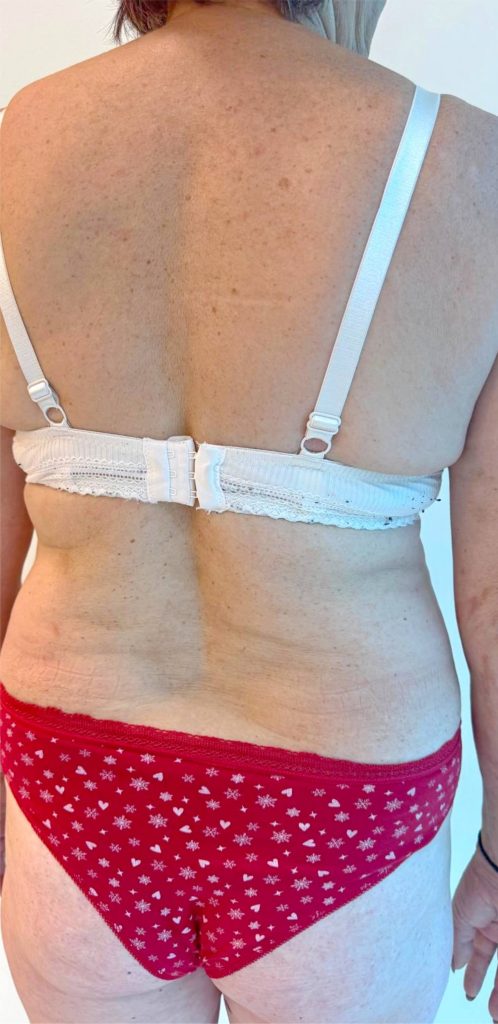 Psoriazis - before - 5